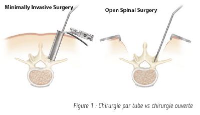 Figure 1 : Chirurgie par tube vs chirurgie ouverte