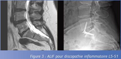 Figure 3 : ALIF pour discopathie inflammatoire L5-S1