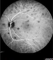 Angiographie-retinienne2.jpg
